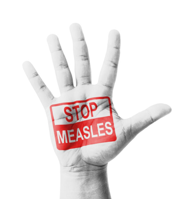 Measles Washington