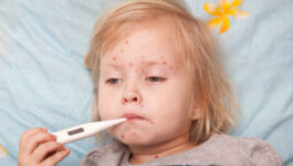 Measles